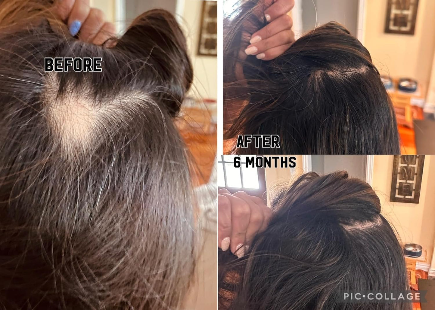 Hair Growth Serum | Aids Regrowth with Redensyl Anagain & Procapil | Hydrates Scalp for Visibly Thicker Hair | Hair Growth & Hair fall control Serum for Women & Men