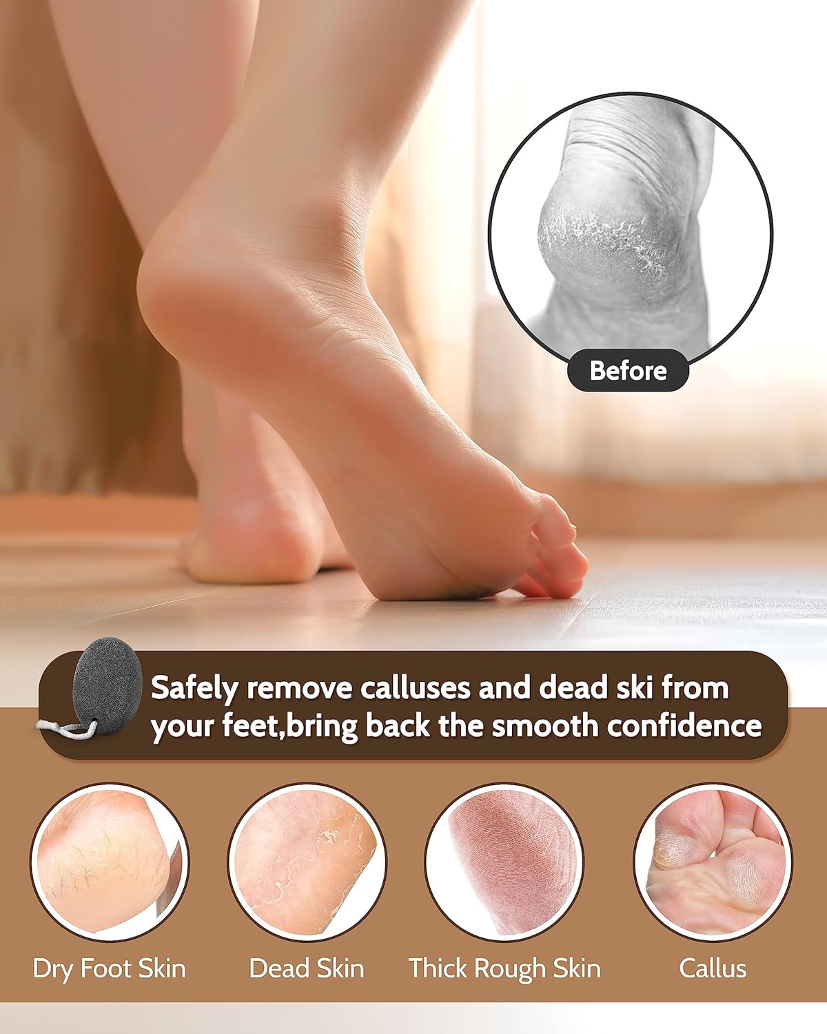 Pumice Stone Foot File, 4pcs Set Callus Remover for Feet with Wooden Handle, Pedicure Foot Scrubber to Remove Dead Skin, Dry, Rough, Corns Skin Scraper